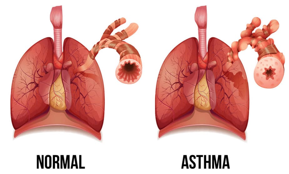 Normal and Asthma Lungs